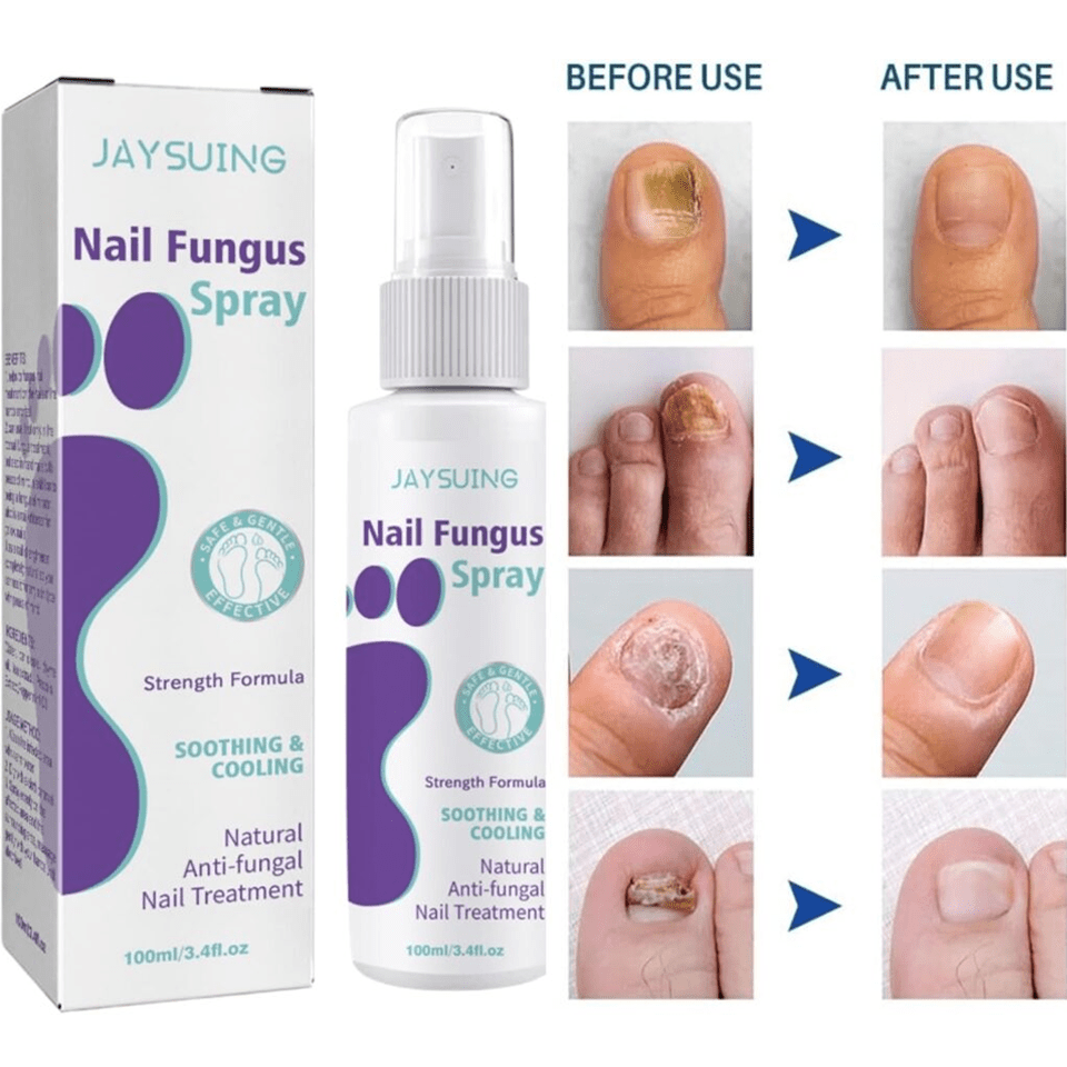 FUNGAL NAIL TREATMENT FOR TOENAILS EXTRA STRONG,100ML SPRAY FOR NAILS